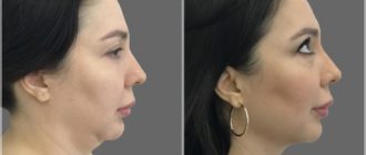 Как убрать второй подбородок